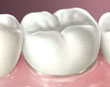 tawana-kronen-en-bruggen-Porcelain kronen en bruggen porcelain